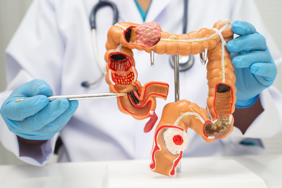 Câncer de Intestino: Quando a prevenção deve começar?